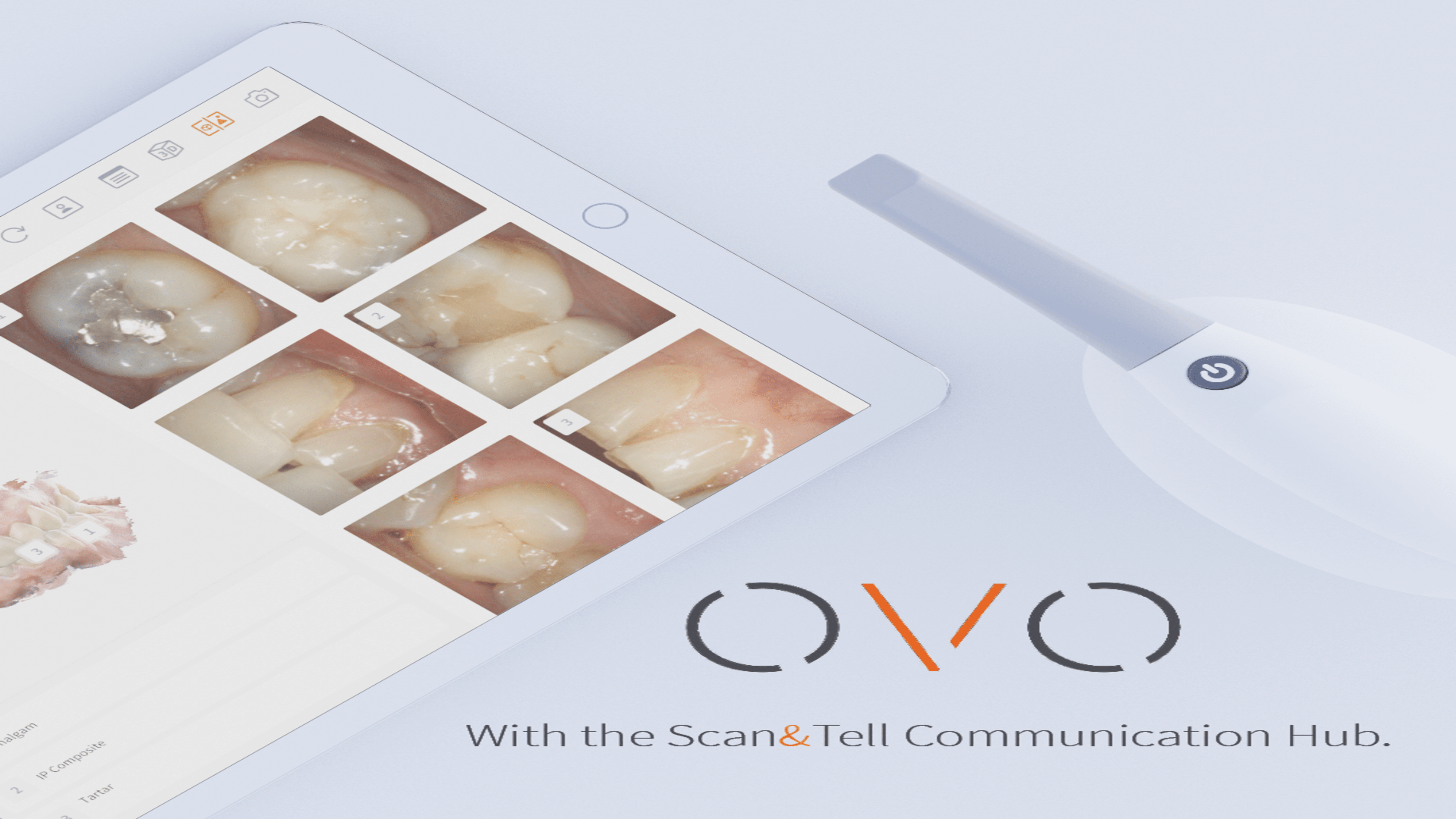 OVO Intraoral Scanner: Transforming the System of Dental Health in India